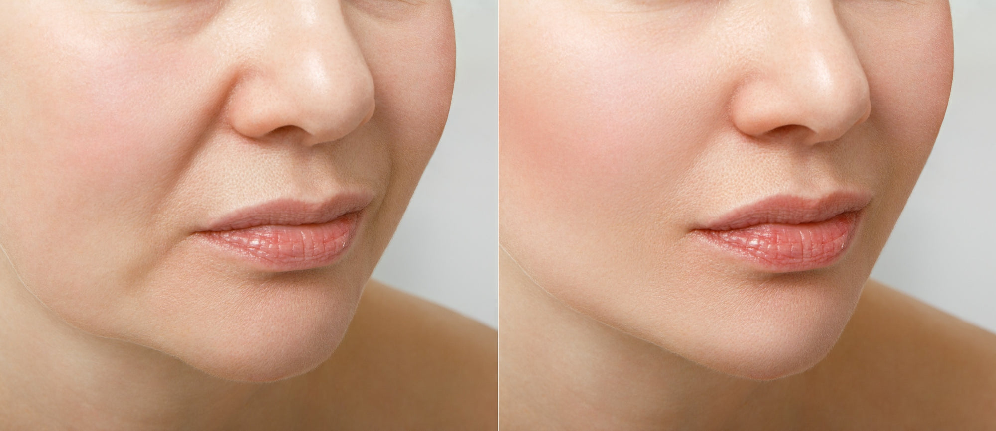 Before and after collagen use of a ladies nose and mouth 